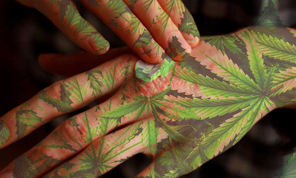 psoriasi e cannabis